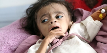 yemen-yetersiz-beslenme-aa-2477710.jpg