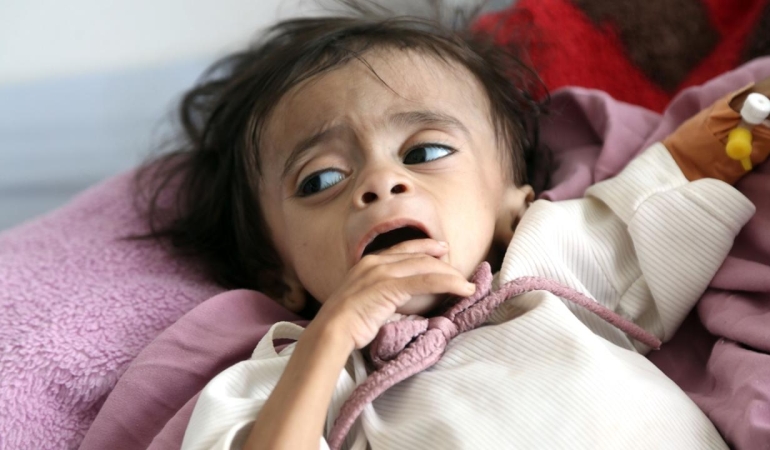 yemen-yetersiz-beslenme-aa-2477710.jpg